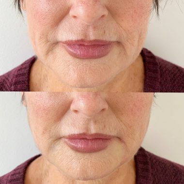 Thread Lift Before and Afters
