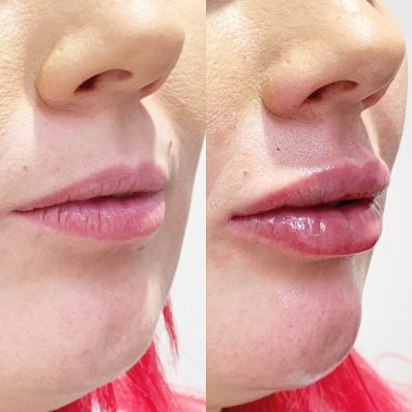 Lip Enhancement Before and Afters