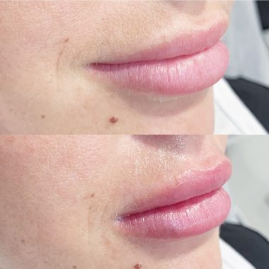 Lip Enhancement Before and Afters