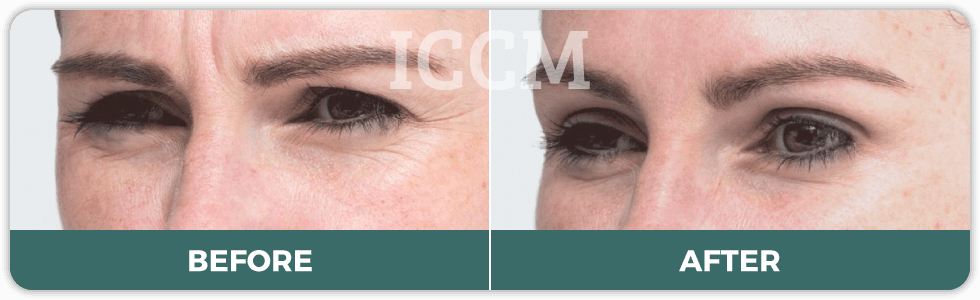anti wrinkle injections before and after