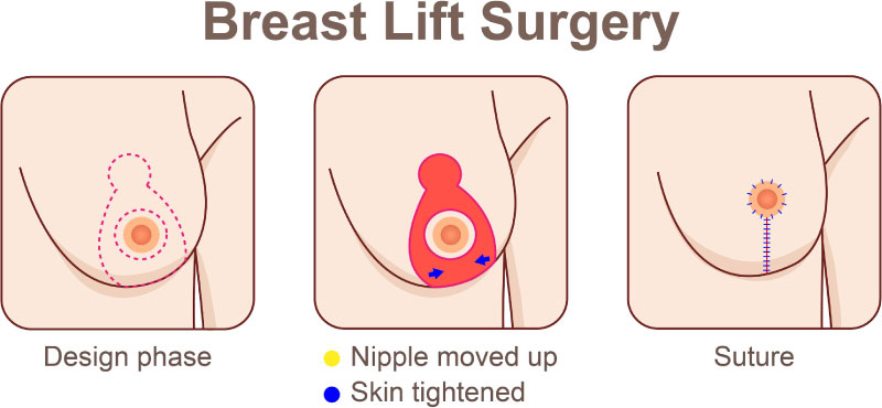 breast lift sydney