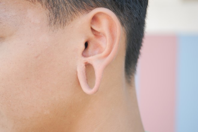 Hey, hipsters: New surgery can reverse stretched-out ear lobes