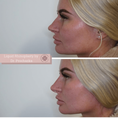 Liquid Rhinoplasty Before and Afters