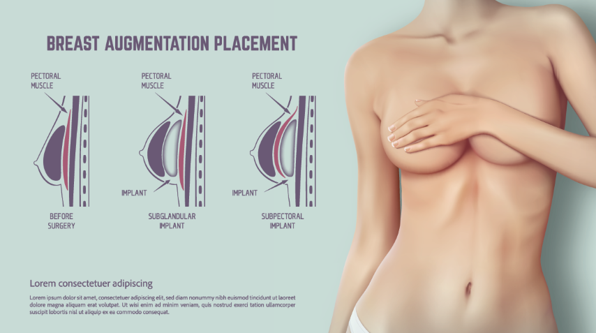 Expert Breast Augmentation Sydney