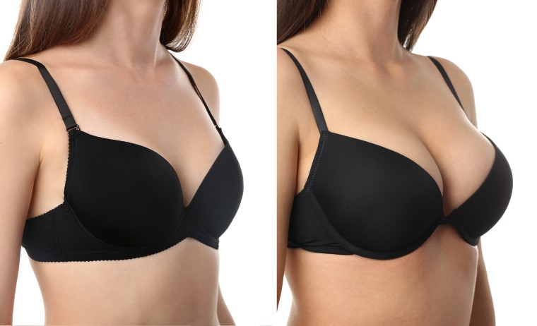 breast augmentation sydney