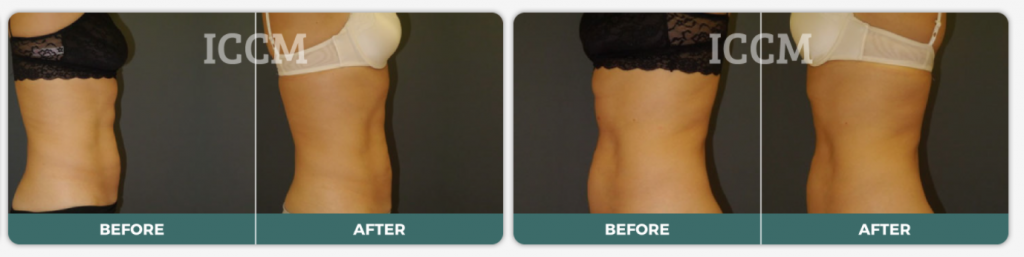 Tummy Tuck or Liposuction?