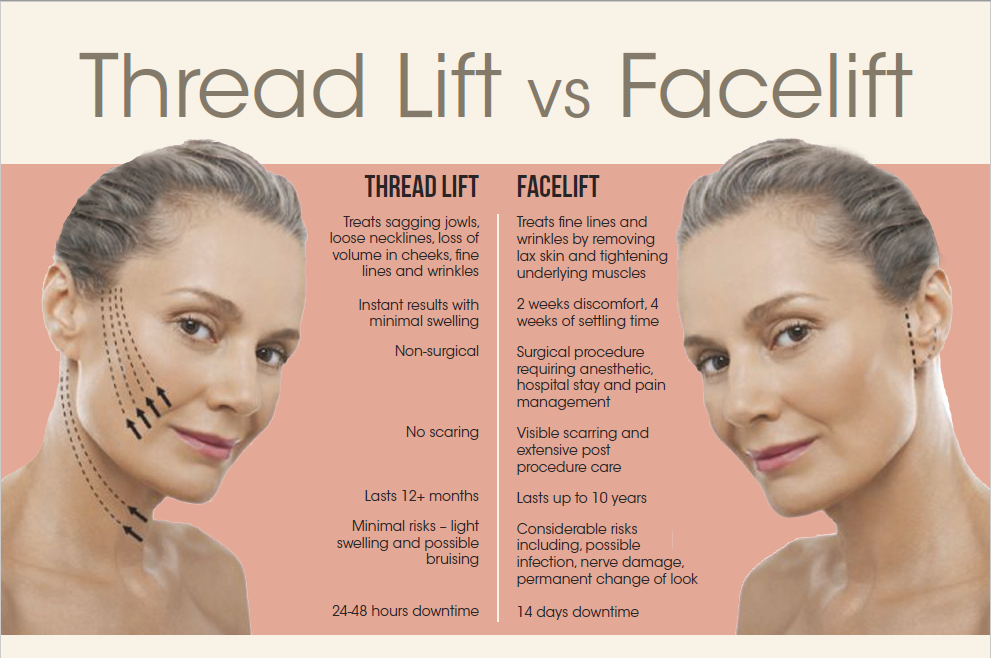 What Is a Thread Lift Procedure?