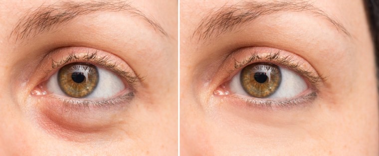 An effective alternative to surgery: Using Plexr to remove eye bags - Dr  Camilla Hill