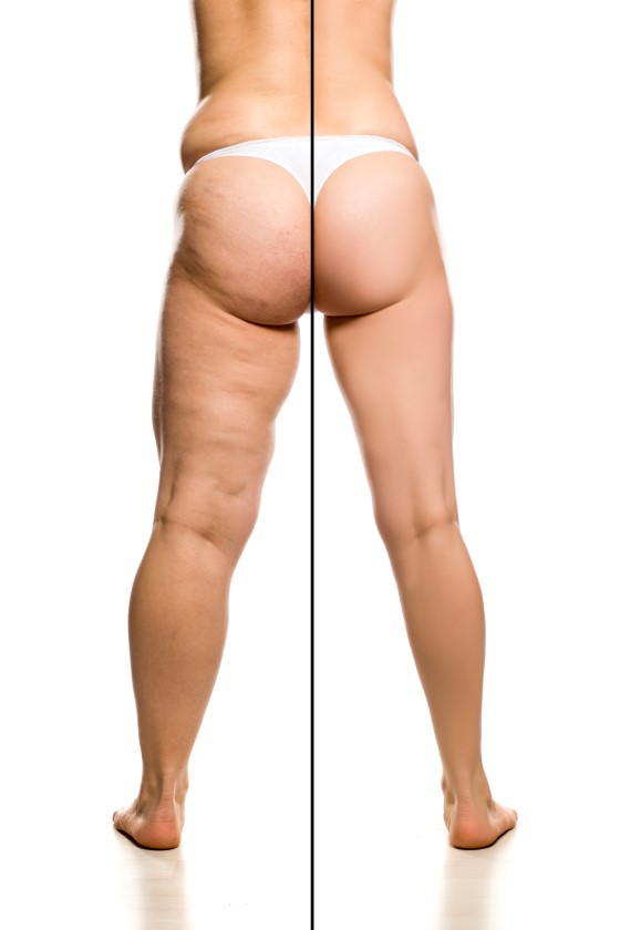 How Long Does Inner Thigh Lipo Last? - Ideal Face & Body