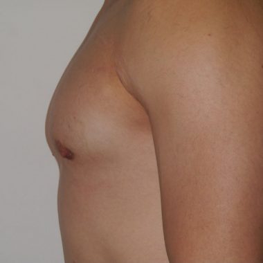 male breast reduction surgery in sydney