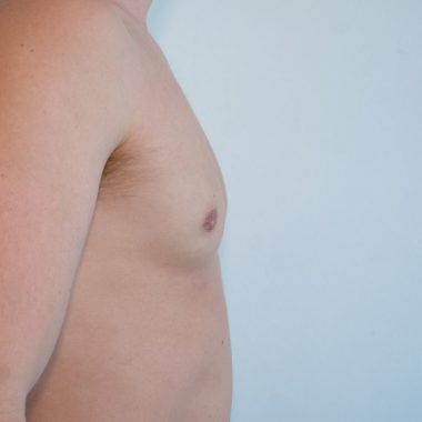 male breast reduction treatment in sydney