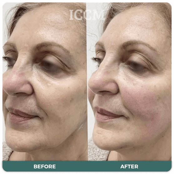 Eyebrow thread lift immediately after lifting the eyebrows. As collagen  builds over the next 90 days these results will continue to get…