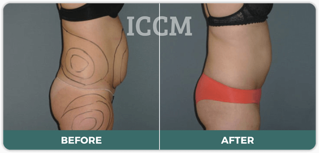 how much weight did you lose after liposuction