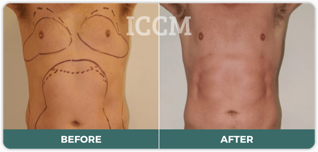 what helps with pain after liposuction