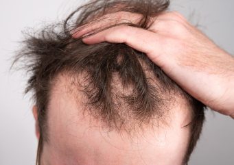 Which vitamin deficiency causes hair loss